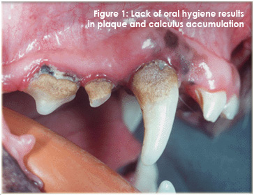  Lack of oral hygiene results in plaque and calculus accumulation